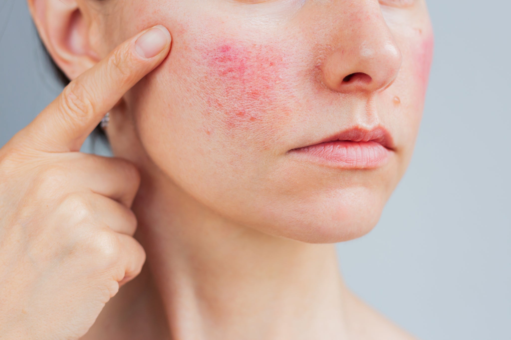 Rosacea auf der Wange